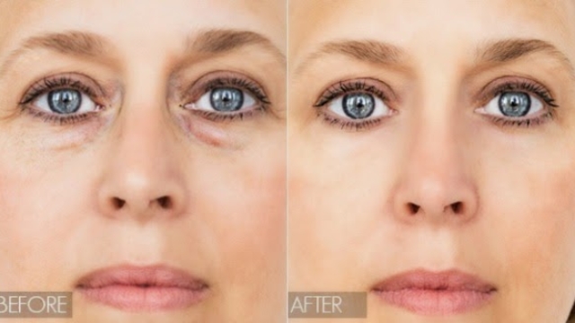 how-to-get-rid-of-eye-bags-fast-and-naturally-in-a-few-days-600x328-1
