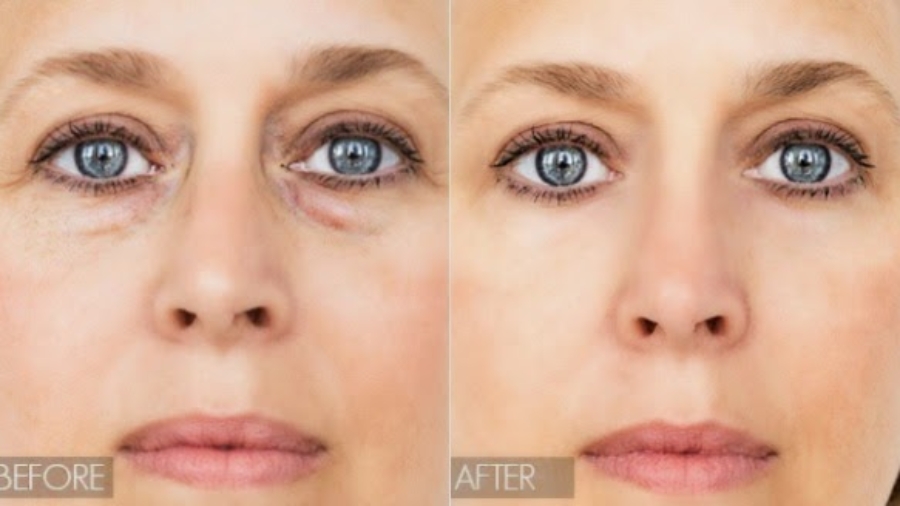 how-to-get-rid-of-eye-bags-fast-and-naturally-in-a-few-days-600x328-1
