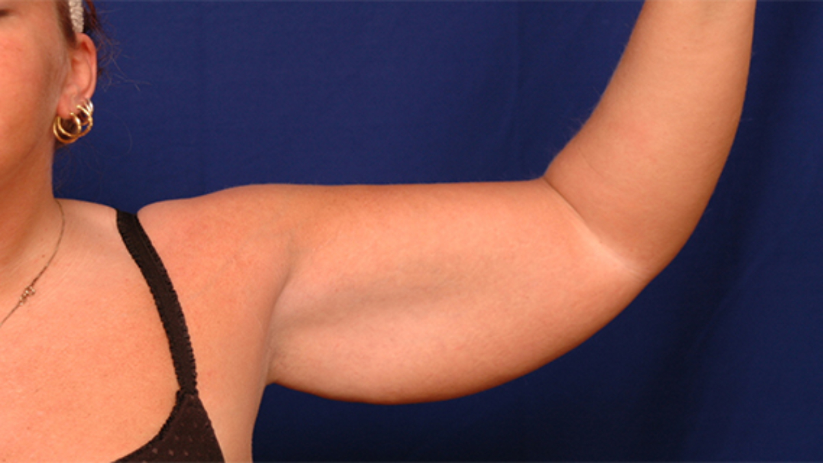 4moyensefficacespourr25C325A9duirelagraissedebras