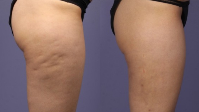 Efficace252Cletraitementnaturelpourlacellulite-Vousaurezbesoindeseulement2Ingr25C325A9dients