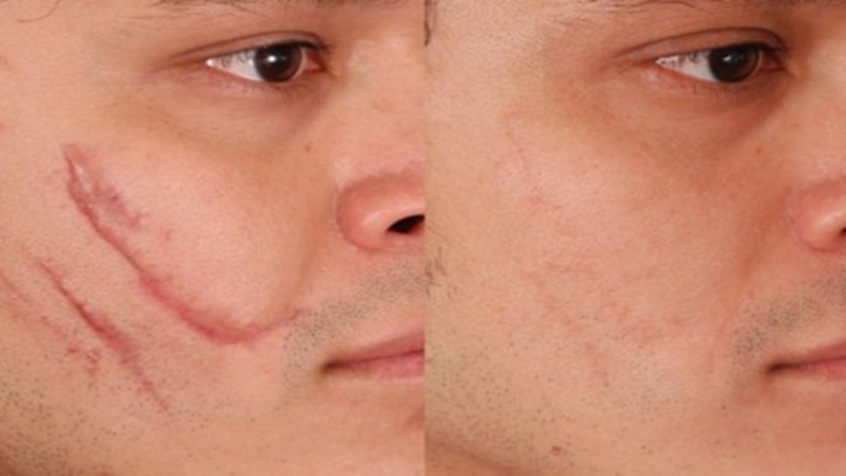 Rem25C325A8desmaisonpourScarRemoval