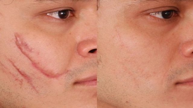 Rem25C325A8desmaisonpourScarRemoval