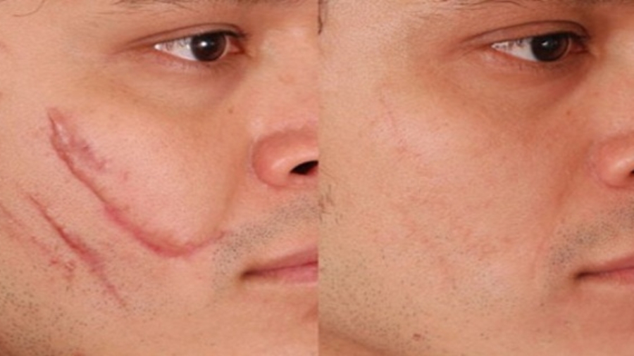 Rem25C325A8desmaisonpourScarRemoval