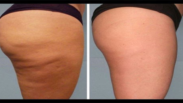 Sed25C325A9barrasserdelacellulitecompl25C325A8tementaveccettem25C325A9thode