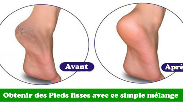 CommentobtenirdesPiedslissesaveccesimplem25C325A9langedebicarbonatedesoude2521