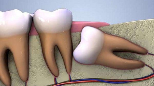 L25E225802599escroqueriedesdentsdesagesseetpourquoivousavezbesoindevosdentsdesagesse