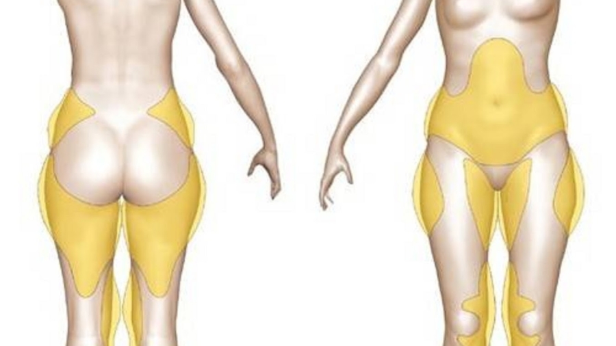 Lisezcetarticlesivousvoulezvousd25C325A9barrasserdelagraissesuppl25C325A9mentairedescertainespartiesdevotrecorps