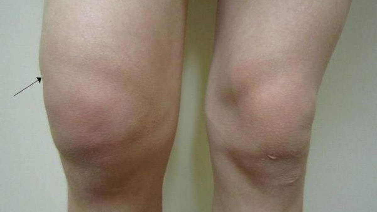 Rem25C325A8denaturelefficacepourtraiterlegonflementdegenou