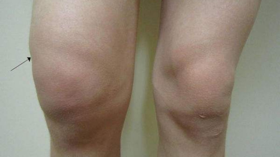 Rem25C325A8denaturelefficacepourtraiterlegonflementdegenou