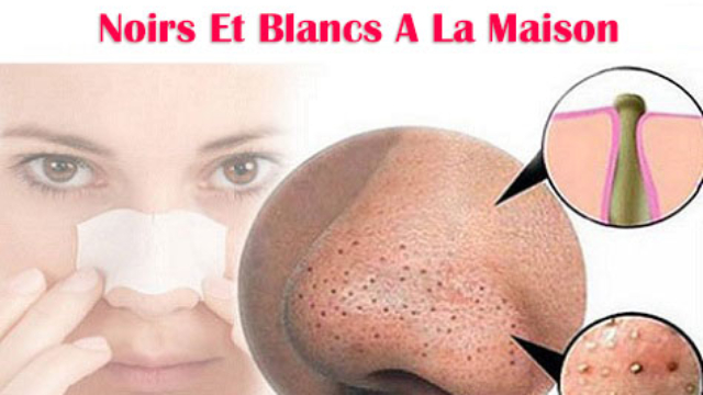 Ceci-Est-Comment-Enlever-Des-Points-Noirs-Et-Blancs-A-La-Maison