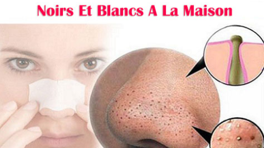 Ceci-Est-Comment-Enlever-Des-Points-Noirs-Et-Blancs-A-La-Maison