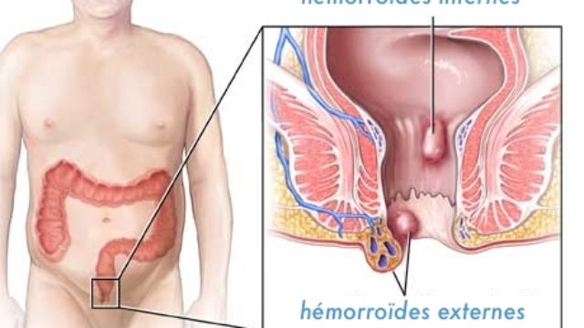 ConseilsD2527auto-SoinsPourLesH25C325A9morro25C325AFdesDeLaCliniqueMayo