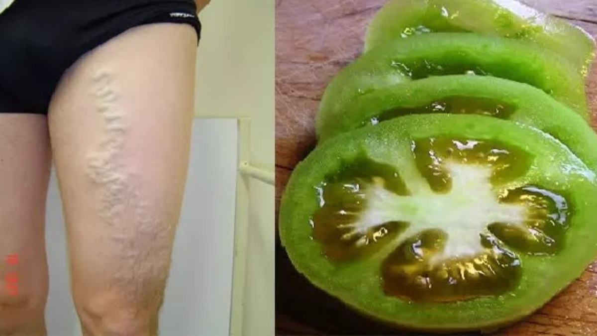 Durcissementvaricesauxtomates