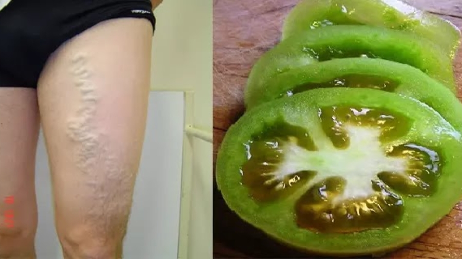 Durcissementvaricesauxtomates