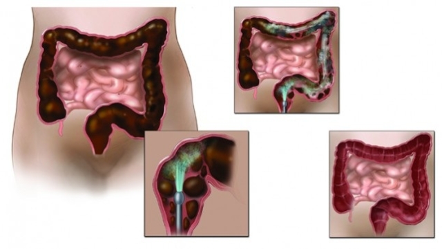 Nettoyezrapidementvotrec25C325B4lonetperdredupoidsenutilisantceplansimpledenettoyageen4parties