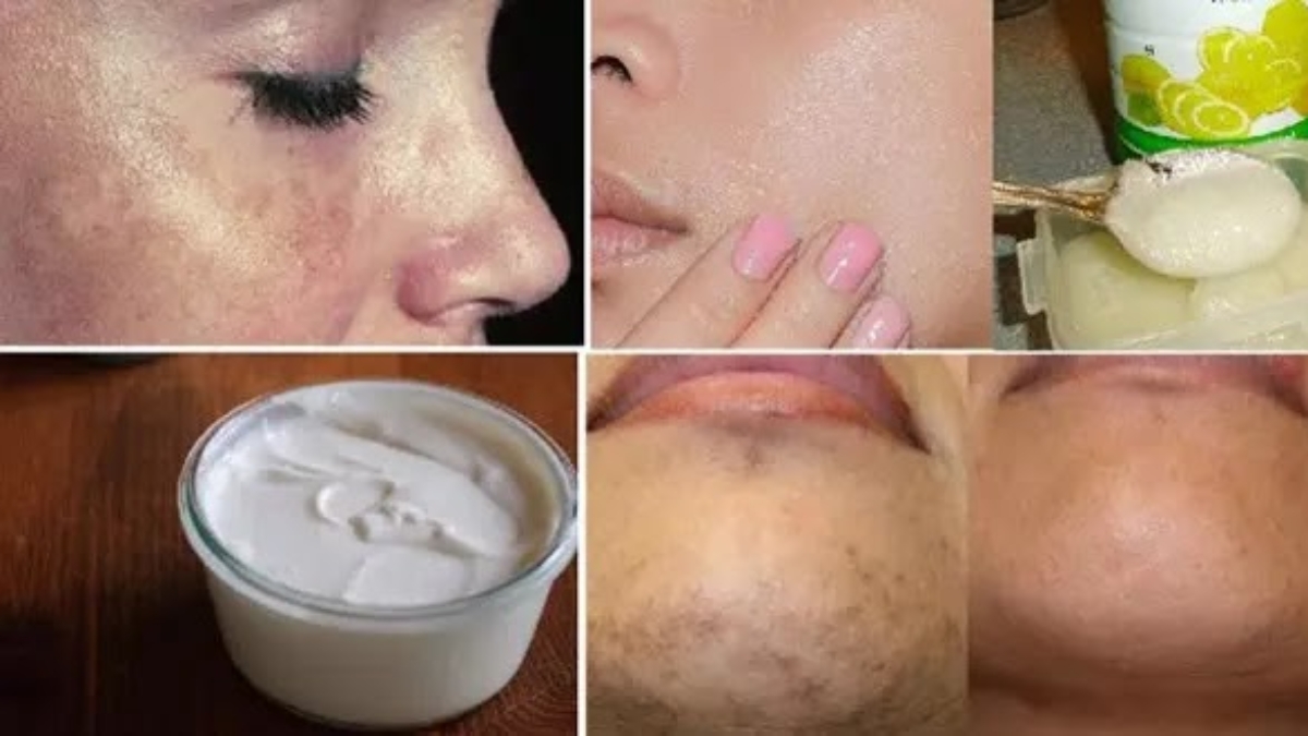 TraitezVotreTachesNoiresAvecCetteSuperHomeRemedies