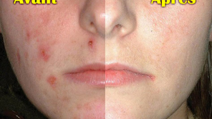 Vraiment-Efficace-Persil-Masque-Pour-Les-Taches-Sombres252C-Acne-Et-La-Peau-Decoloree