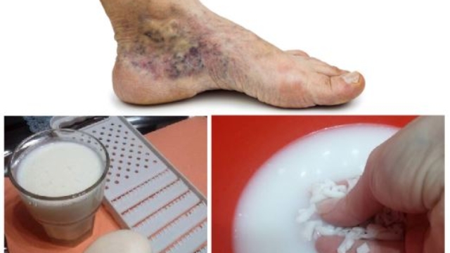 Recettemagiquepourlesvaricesetthromboseavecseulement2SimplesIngr25C325A9dients2521