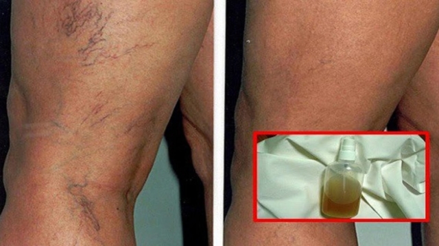 Rem25C325A8desnaturelspourtraiteravecsucc25C325A8slafragilit25C325A9capillairesetlesvarices