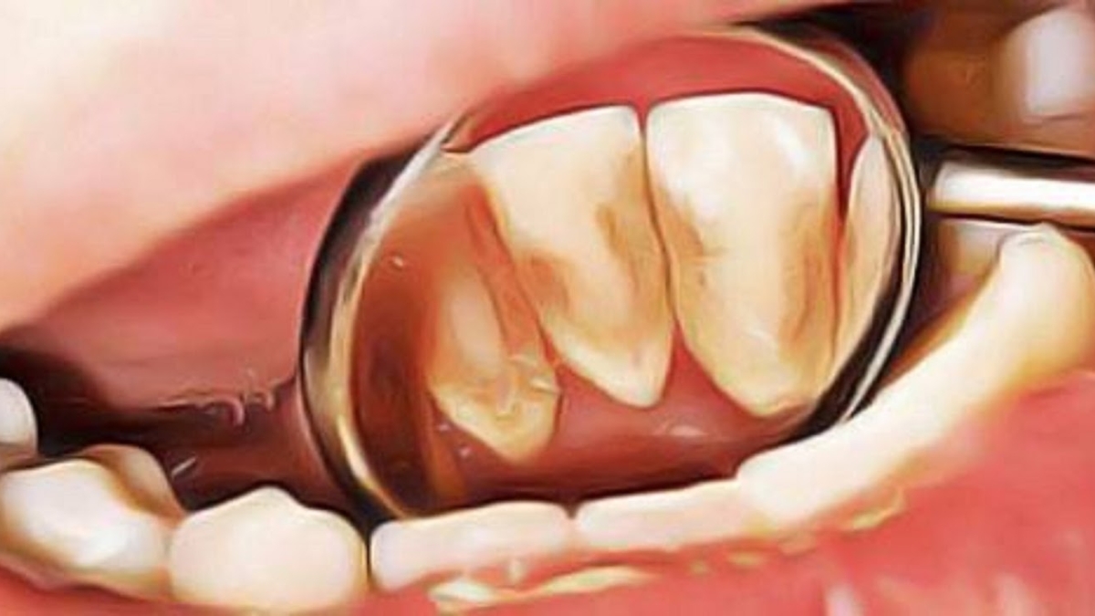 Suivezcesastucesnaturellespouravoirdesdentsblanches252Csainesetsanstartre