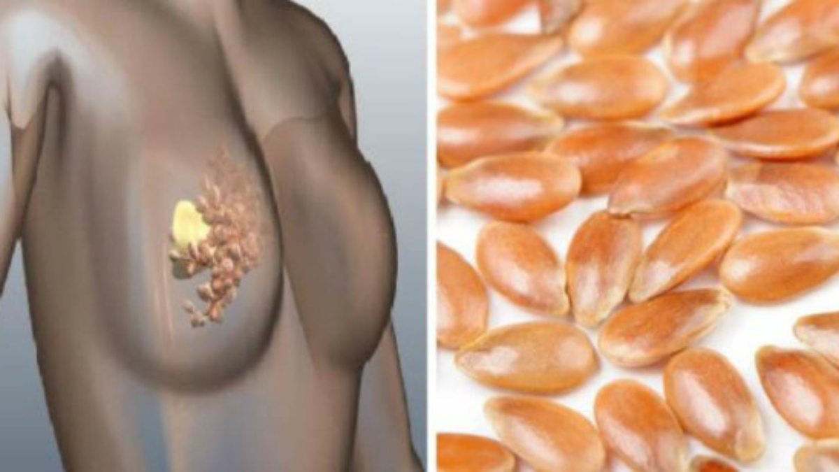 Commentpr25C325A9veniretdegu25C325A9rirlecancerduseinavecuningr25C325A9dientnaturel2521