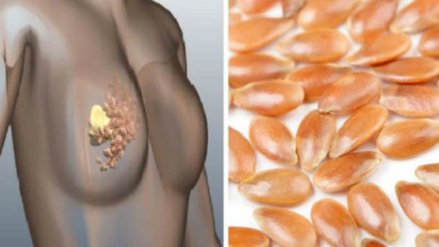 Commentpr25C325A9veniretdegu25C325A9rirlecancerduseinavecuningr25C325A9dientnaturel2521