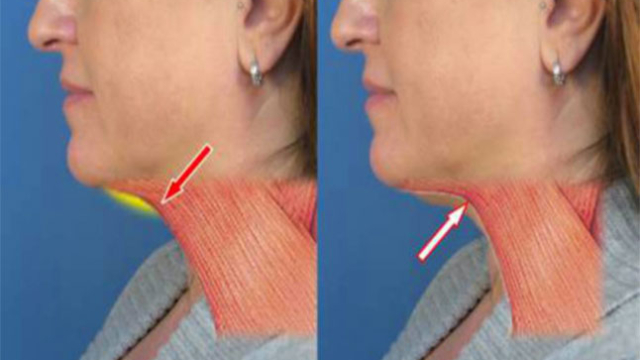 Voici-tout-ce-que-vous-devez-savoir-25C325A0-propos-visage-et-le-graisse-de-cou-Et-Comment-se-d25C325A9barrasser-d2527elle2521