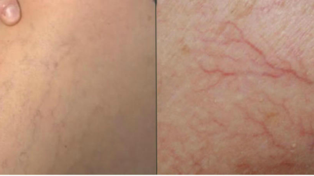 Voicicommentsed25C325A9barrasserdesvaricosit25C325A9sAvecCesAccueilpuissantsrem25C325A8des2521