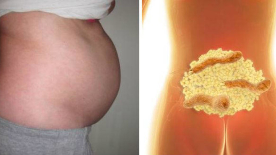 Voilapourquoivousavezuneventreballonn25C325A9etCommentsed25C325A9barrasserdeballonnementsetdeperdredupoidspendantlanuit2521