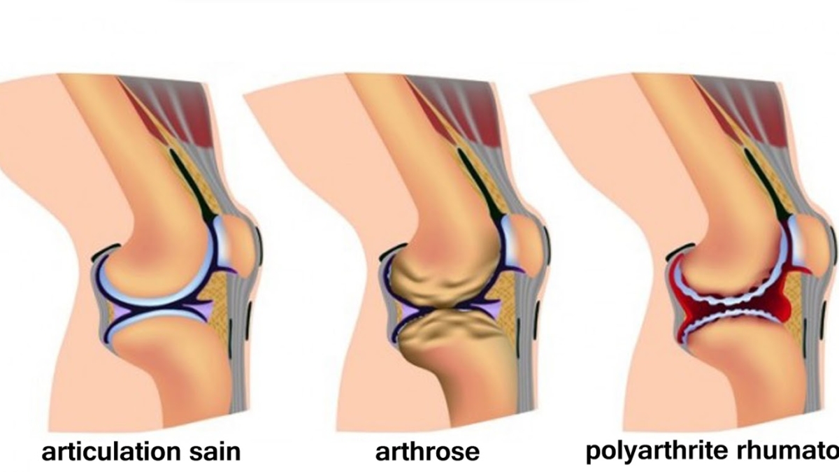 Votrer25C325A9gimealimentaireprovoquantuneinflammationetl2527arthrite252CVoici7fa25C325A7onsdelesemp25C325AAcher
