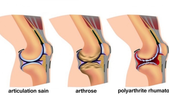 Votrer25C325A9gimealimentaireprovoquantuneinflammationetl2527arthrite252CVoici7fa25C325A7onsdelesemp25C325AAcher
