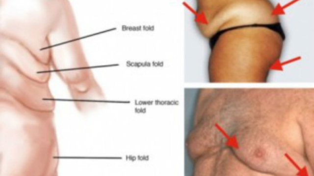 Why-The-Body-Redistributes-Fat-as-We-Age-and-How-to-Prevent-It-326x235-600x432-1