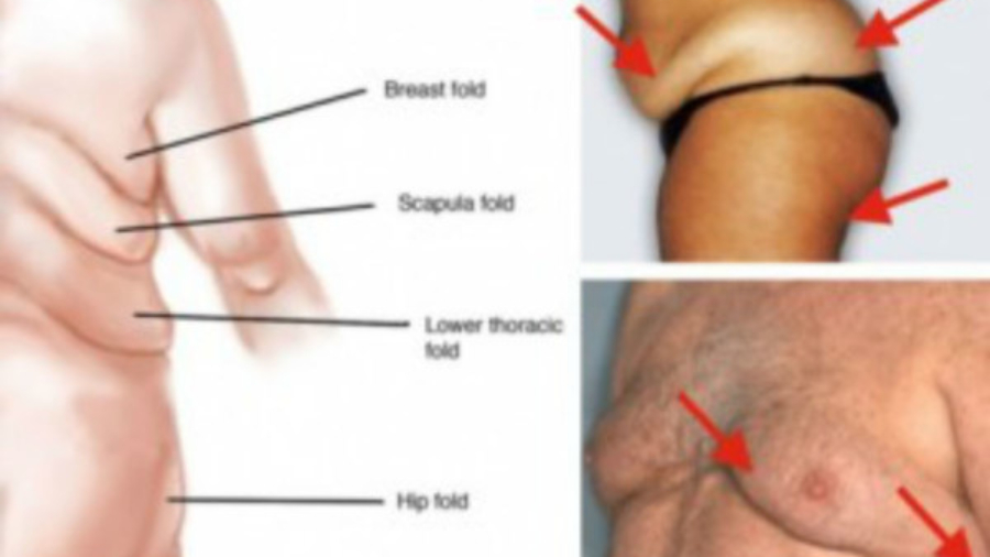 Why-The-Body-Redistributes-Fat-as-We-Age-and-How-to-Prevent-It-326x235-600x432-1