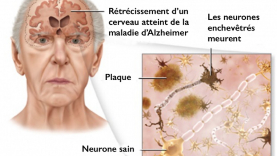 425C325A9tapesessentiellespourpr25C325A9venirlamaladied2527Alzheimer2521