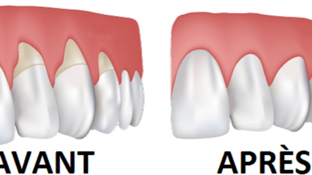 Traiterlar25C325A9cessiongingivaleAveccesrem25C325A8desmaison