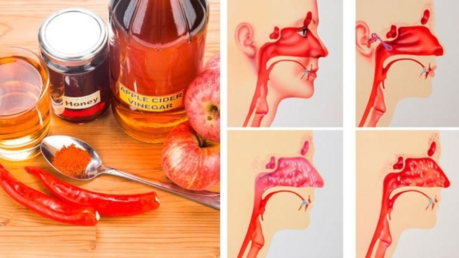 Tuerl2527infectiondessinusenquelquesminutes252Caveccequevousavezdansvotrecuisine2521